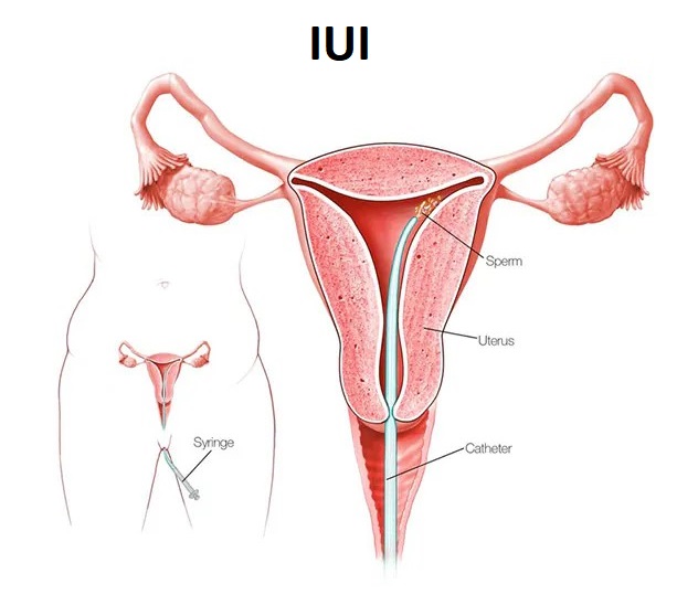 intrauterine-insemination-IUI